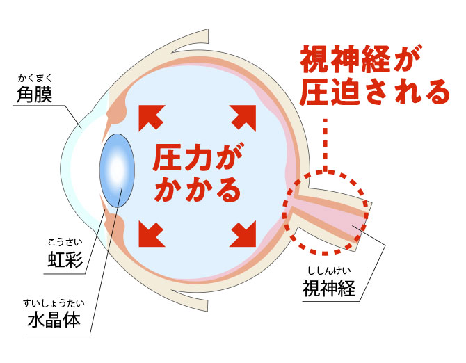 緑内障の眼の断面図