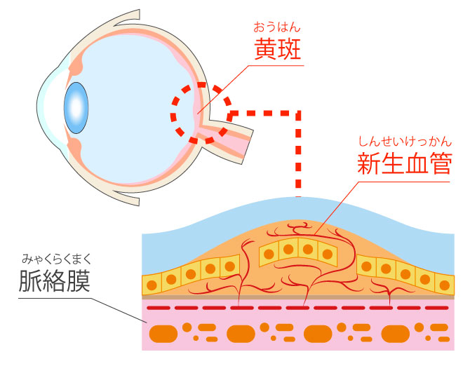 黄斑変性の眼の断面図