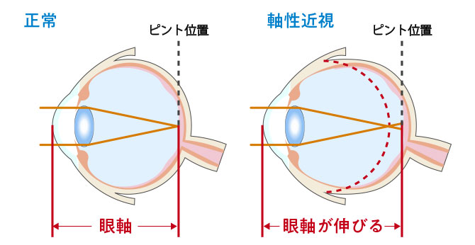 正常な眼の断面図と軸性近視の眼の断面図