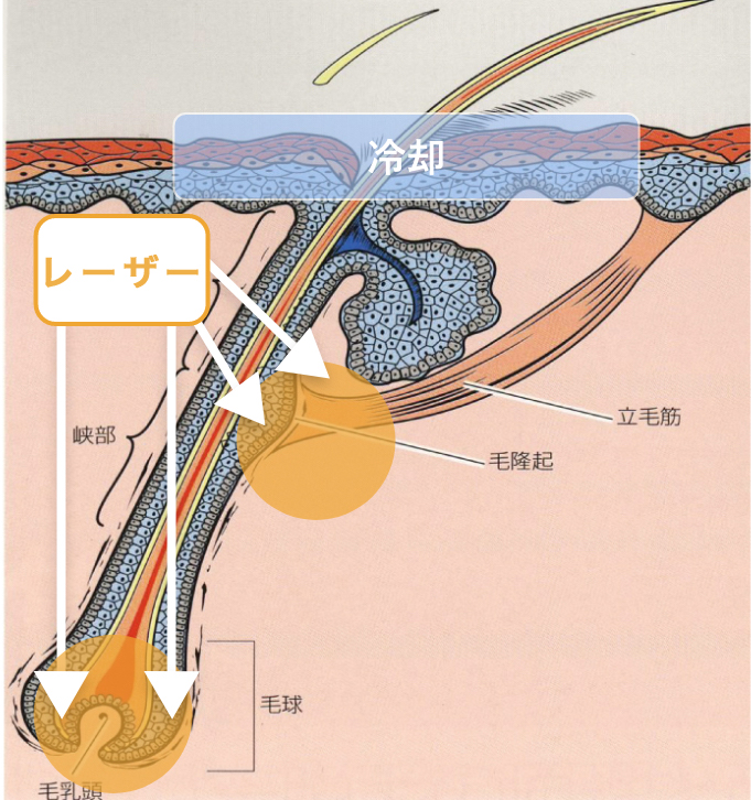 脱毛のプロセス