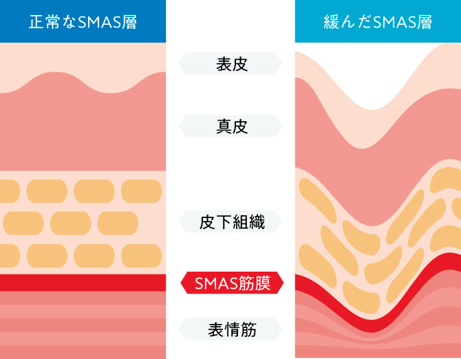 SMAS層の断面図