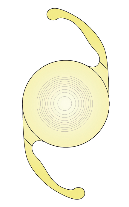 単焦点眼内レンズの特徴