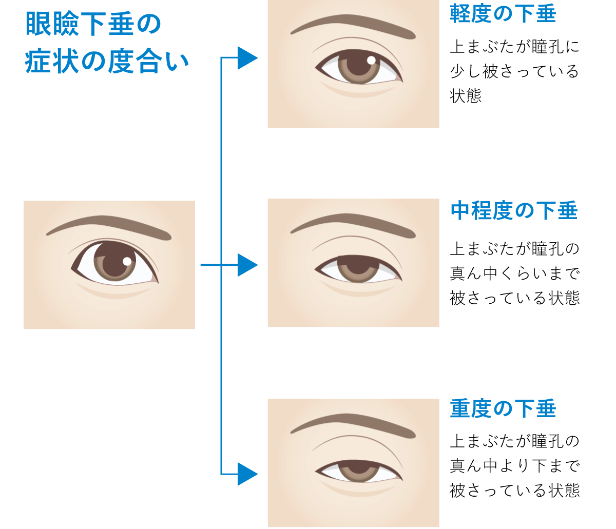 眼瞼下垂症の症状の度合い