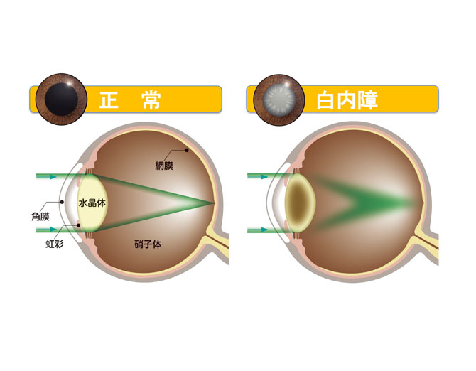 ものが見える仕組みと白内障の図