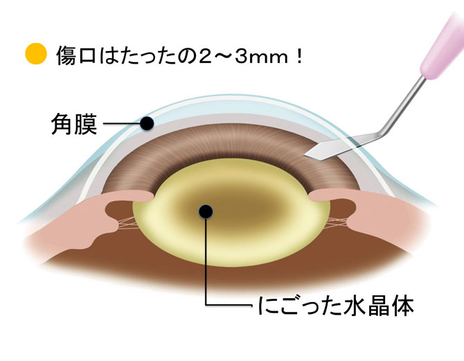 眼球切開の図