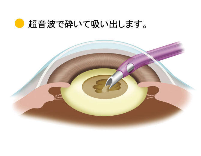 水晶体の吸引の図