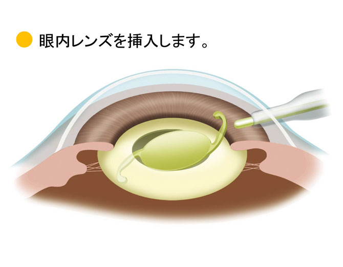 眼内レンズ挿入の図