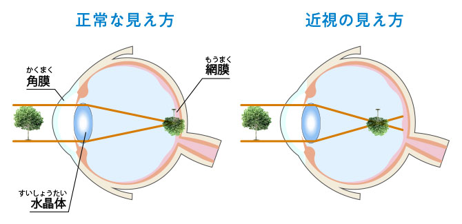 正常なものの見え方と近視の見え方の断面図