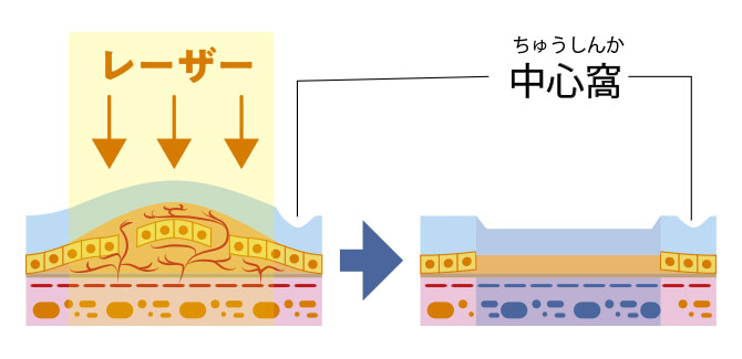 レーザー光凝固の断面図