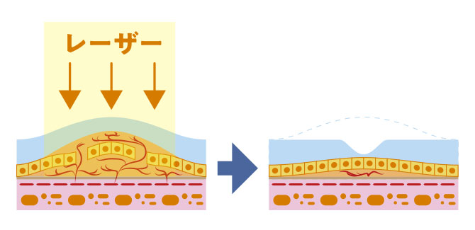 光線力学的療法(PDT)の断面図