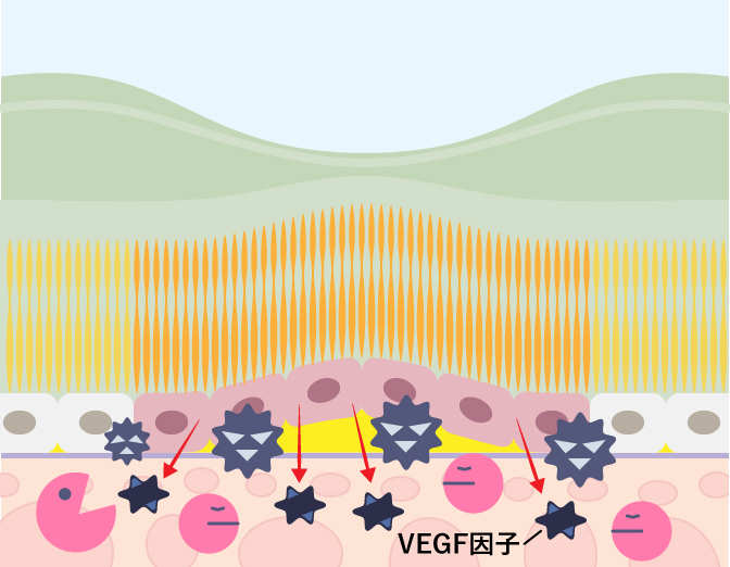 黄斑変性のVEGFが増えた断面図