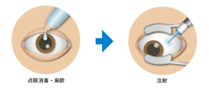 点眼消毒・麻酔、注射の図