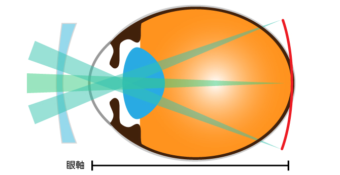 メガネ、コンタクト着用時の眼軸の様子