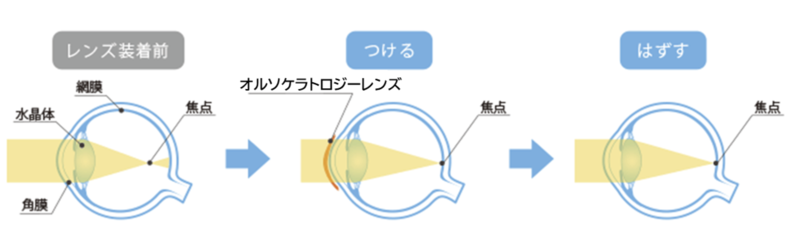 オルソケラトロジーレンズ