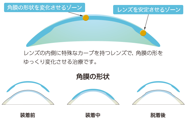 オルソケラトロジーレンズ